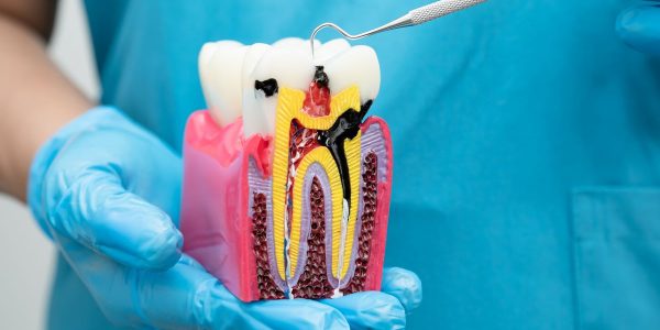 Endodoncia en Barcelona