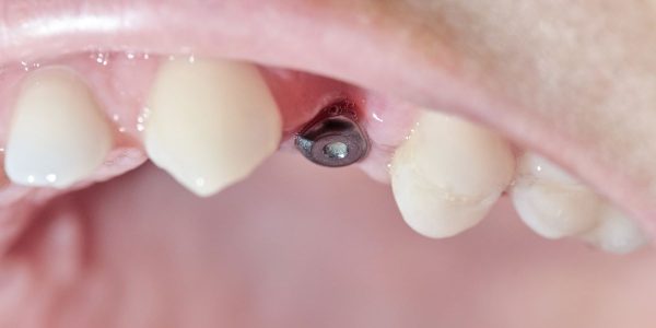 implantes dentales en barcelona